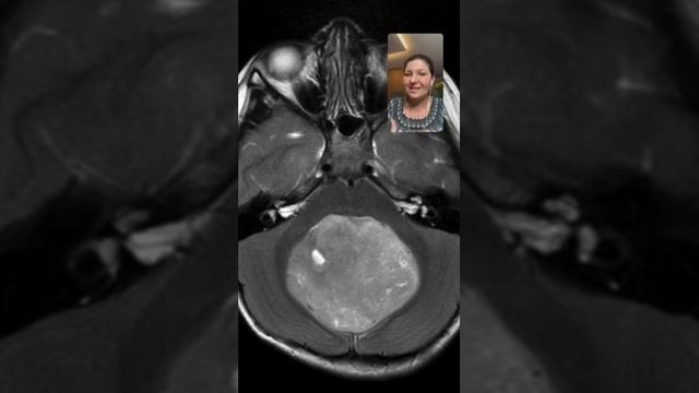 Quem é o meduloblastoma? смотреть онлайн