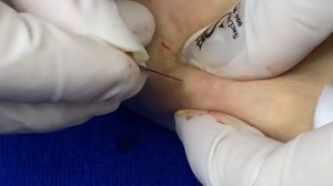 Humungus Steatocystomas Multiplex Removal - KRT17 Gene Mutation