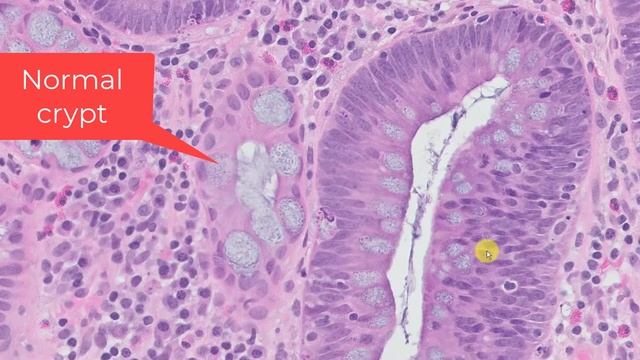 The Diagnosis of a Tubular Adenoma