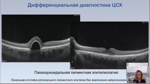 Вебинар Центральная серозная хориоретинопатия