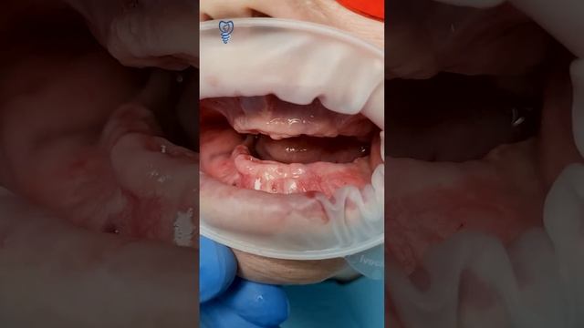 Полностью беззубая челюсть и новая улыбка. Имплантация зубов.
