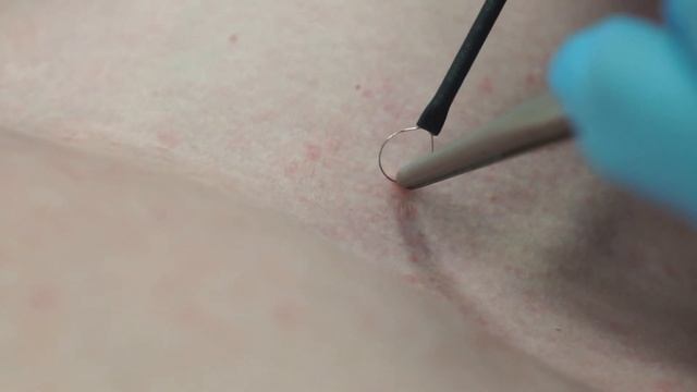 Радиоволновое удаление новообразований.