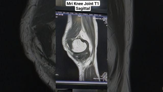 Unveiling the Secrets of MRI Knee T1-Weighted Sagittal View | Anatomy & Radiology