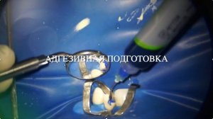 Стекловолоконный штифт. Пример реставрации зуба с помощью стекловолоконного штифта