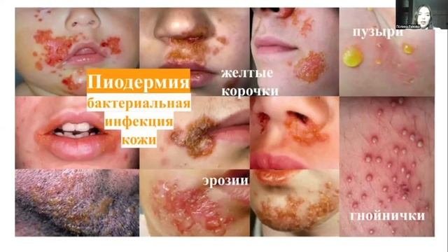 Кожный зуд в клинической практике терапевта и дерматолога