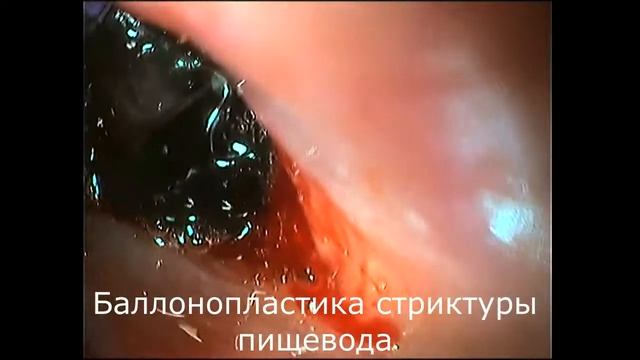 Баллонопластика пищевода при стриктуре у собаки| Esophageal balloon surgery for a stricture in a do