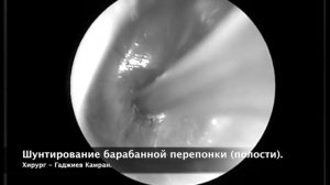 Шунтирование барабанной полости у ребенка с экссудативным отитом/ tympanostomy tube/ Камран Гаджие