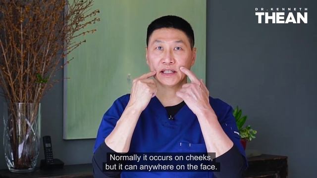 What is Melasma and how to remove it? | Dr Kenneth Thean