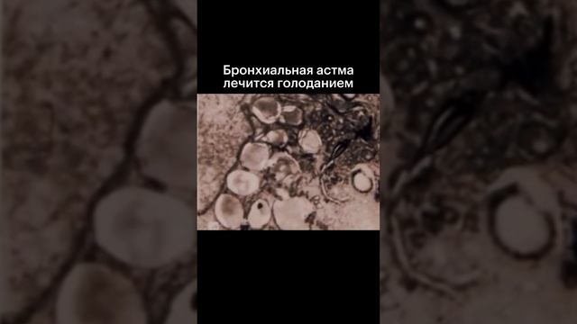 Бронхиальная астма