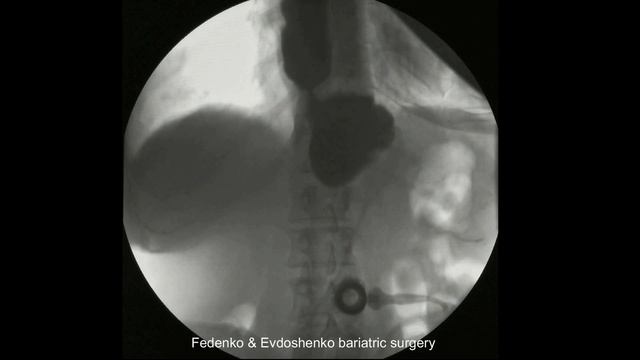 бандажирование желудка, непроходимость смотреть онлайн