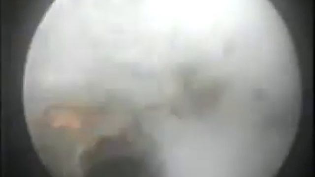 Лазерное рассечение стриктуры уретры. смотреть онлайн