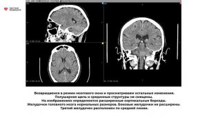 Исследование компьютерной томографии головного мозга Невринома слухового нерва