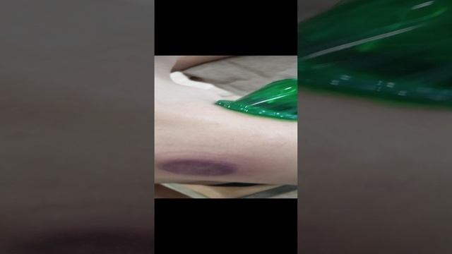 Постановка банок при боли в плечевом суставе