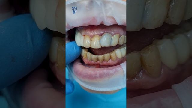 Процесс установки временного моста и 6 имплантатов. Имплантация зубов.