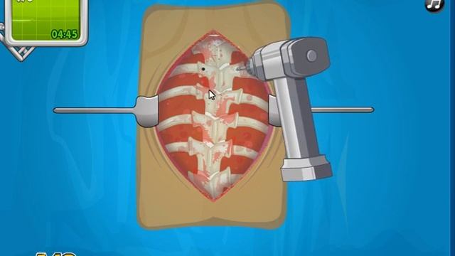 Operate Now| оперируем сколиоз