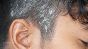 Dandruff Removal on Front Side of Head!! Itchy Dry Scalp Dandruff Scratching #02