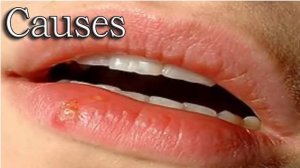Herpes simplex virus:  Causes ,Symptoms & permanent cure with no side effect