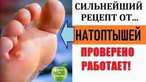 Как избавиться от натоптышей - Эффективный и Абсолютно бюджетный рецепт.