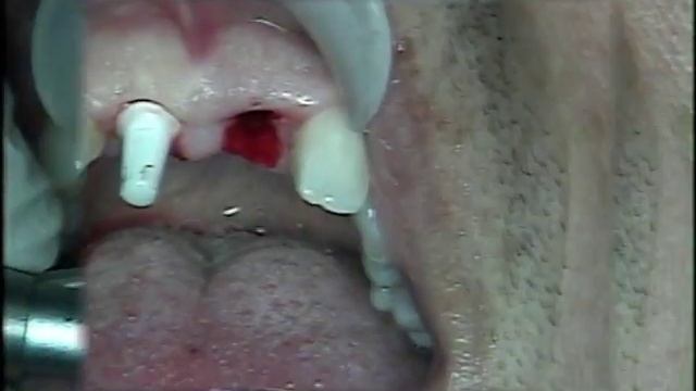 Immediate Zirconium Dioxide Dental Implant at The Lanap and Implant Center of Pennsylvania смотреть онлайн