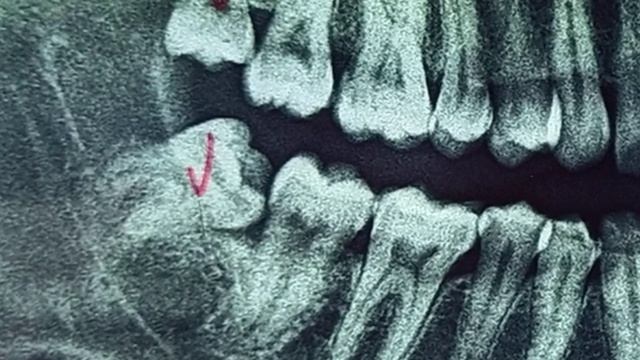 Impaksi gigi geraham bungsu смотреть онлайн