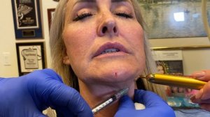 Full Face Botox Demonstration