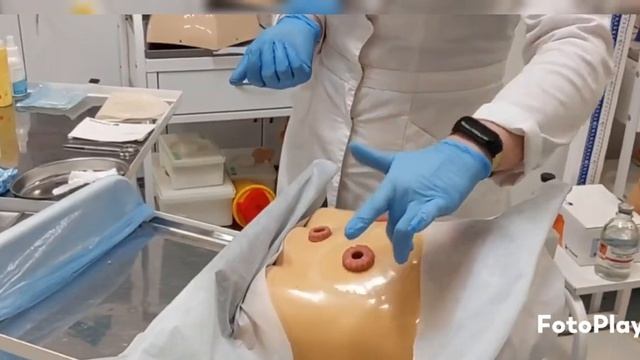 Уход за колостомой, смена калоприемника