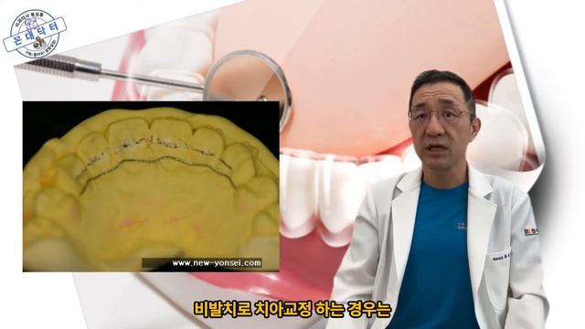치아교정 끝난줄 알았는데 치아교정 후 붙힌 고정식 유지장치 유지철사 언제까지 하나?