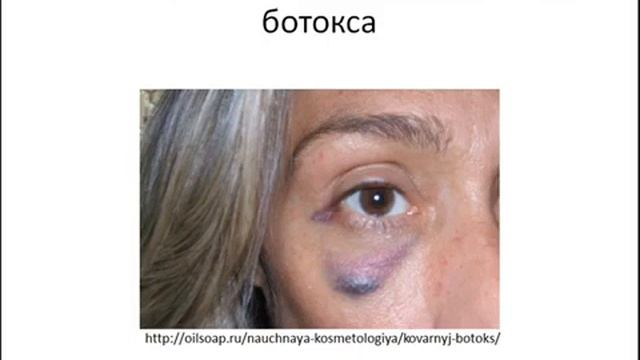 Новый пептидный гель с эффектом ботокса