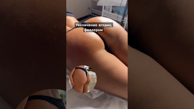 Увеличение ягодиц филлером #губымосква #обучениекосметологов #ягодицы