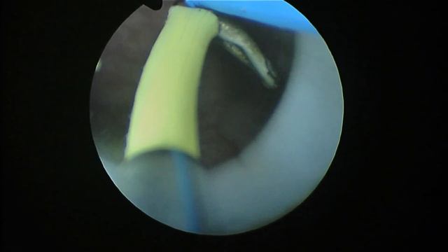 Уретероцеле. Трансуретральная резекция. Случай #33. смотреть онлайн