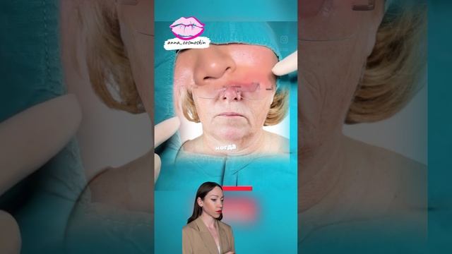 Как поднять уголки губ #губымосква #контурнаяпластикагуб #обучениекосметологов