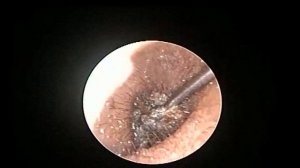 Hard Impacted Huge Ear Wax removal in single stroke