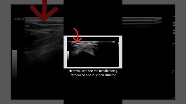 #ultrasound Guided Interventions: Cases (Subacromial Bursa Injection)