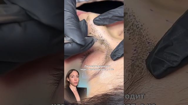 Ринопластика без хирурга #губымосква #обучениекосметологов  #ринопластика