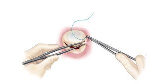 Криолабиринт + Пластика митрального клапана.