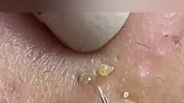 10 Shocking Blackhead Removals
