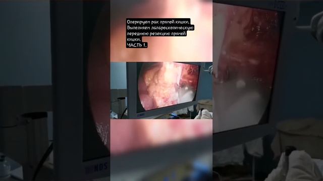 Лапароскопическая передняя резекция прямой кишки. #онколог #онкологпроктологворонеж #рждмедицина