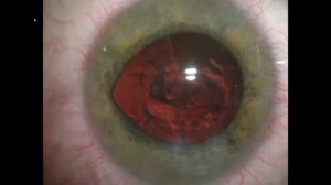 Факоэмульсификация катаракты