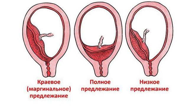 ПОКАЗАНИЯ К КЕСАРЕВО СЕЧЕНИЮ | КОГДА КЕСАРЕВО НЕОБХОДИМО