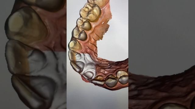 CEREC в работе ! Стас Белоус Стоматолог Ульяновск