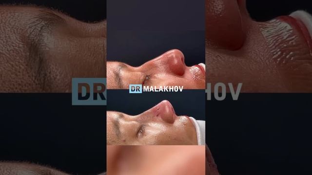 Ринопластика любой сложности 🔥