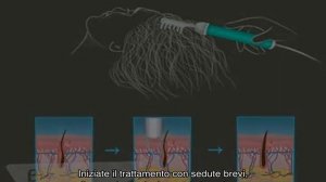 Come utilizzare l’apparecchio Darsonval contro la caduta dei capelli