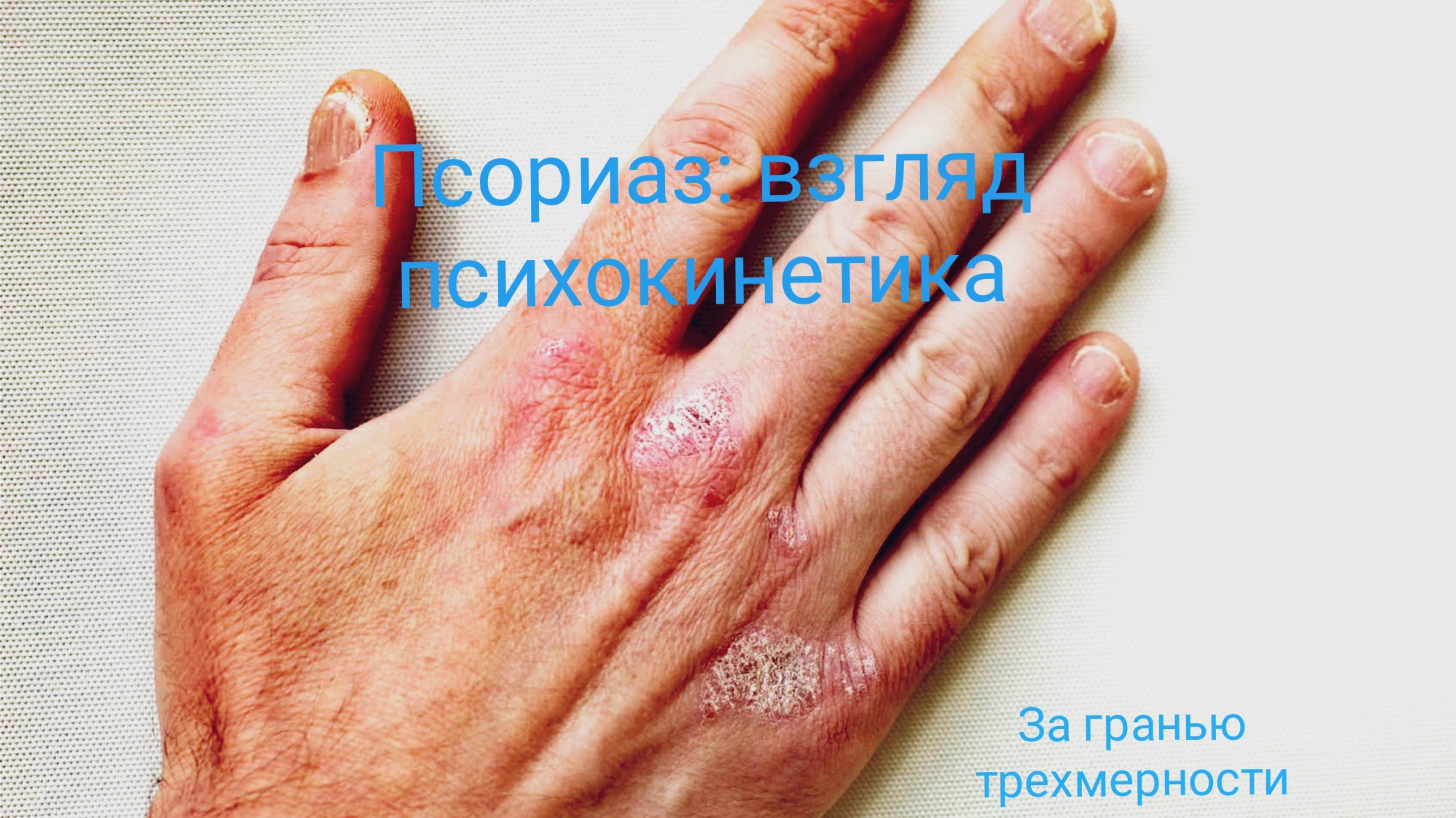 Псориаз: взгляд психокинетика