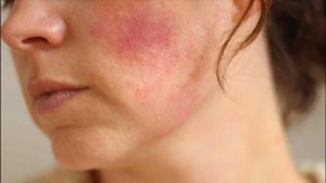 Врач рассказала, как проявляется аллергия на холод