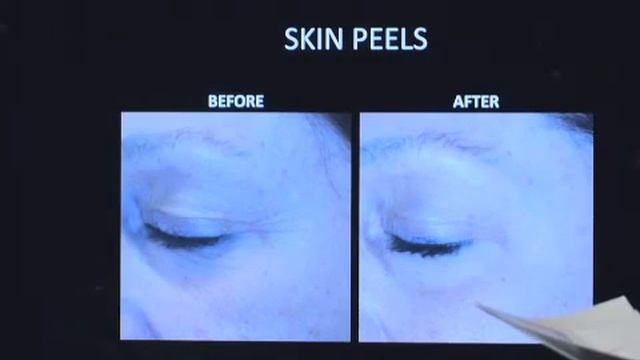 Learn how a skin peel can turn back time
