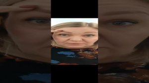 Паралич Белла (паралич лицевого нерва), три недели спустя.