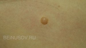 Радиоволновое удаление