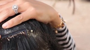 Recue Poor Girl with many Dandruff on Head