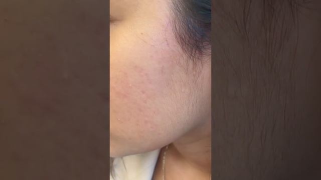 Hyperpigmentation vs. Redness #shorts