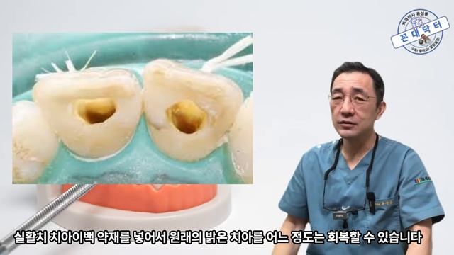 변색된 앞니를 하얗게 해주는 실활치아 치아미백  Walking Bleaching, Non-Vital Bleaching